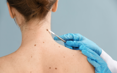 Cancer de la peau : un traitement testé à Villejuif