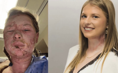 Une Canadienne de 18 ans devient la première patiente au monde à recevoir une thérapie révolutionnaire contre les brûlures